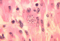 250px-Trypanosoma_cruzi_heart.jpg