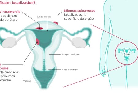 Miomas podem prejudicar mais a qualidade de vida das mulheres do que algumas doenças crônicas